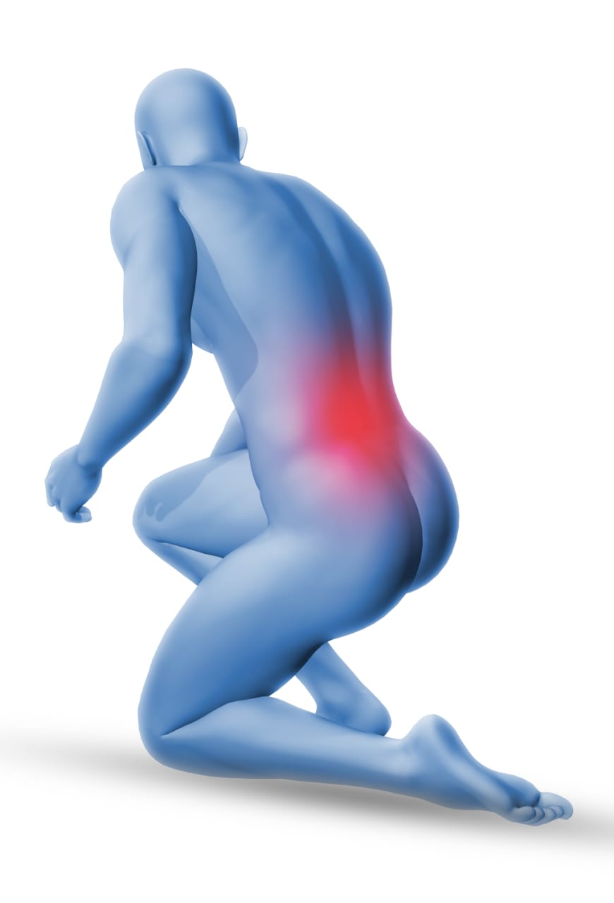 Sciatica