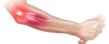 Tennis Elbow