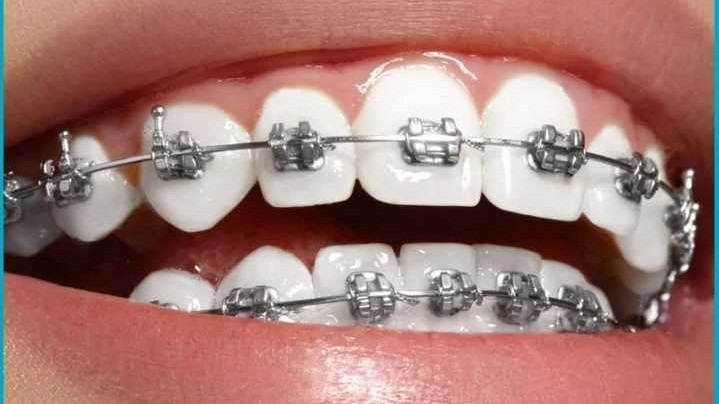 Braces & Aligners Treatment