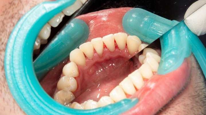Teeth Cleaning & Scaling