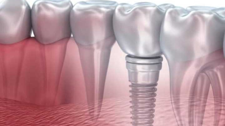 Dental Implants in Alambagh