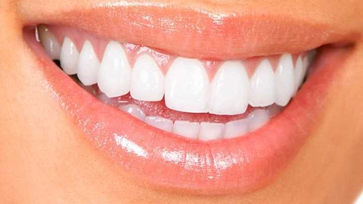 Teeth Whitening Treatment