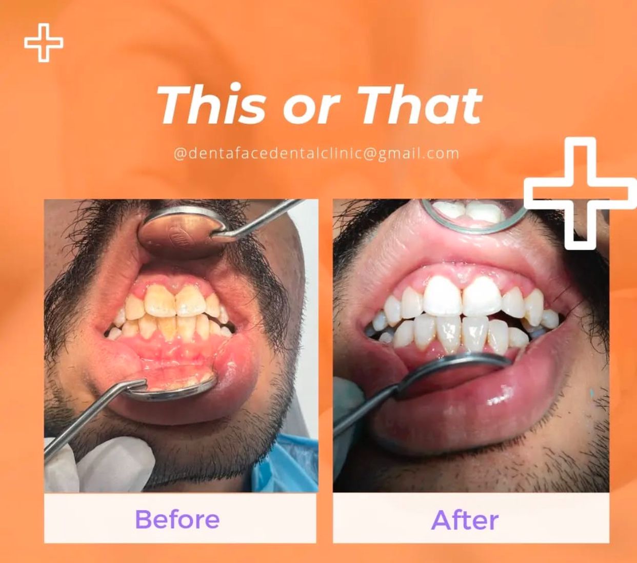 Best Dental Clinic in Sargasan, Gandhinagar - DENTAFACE