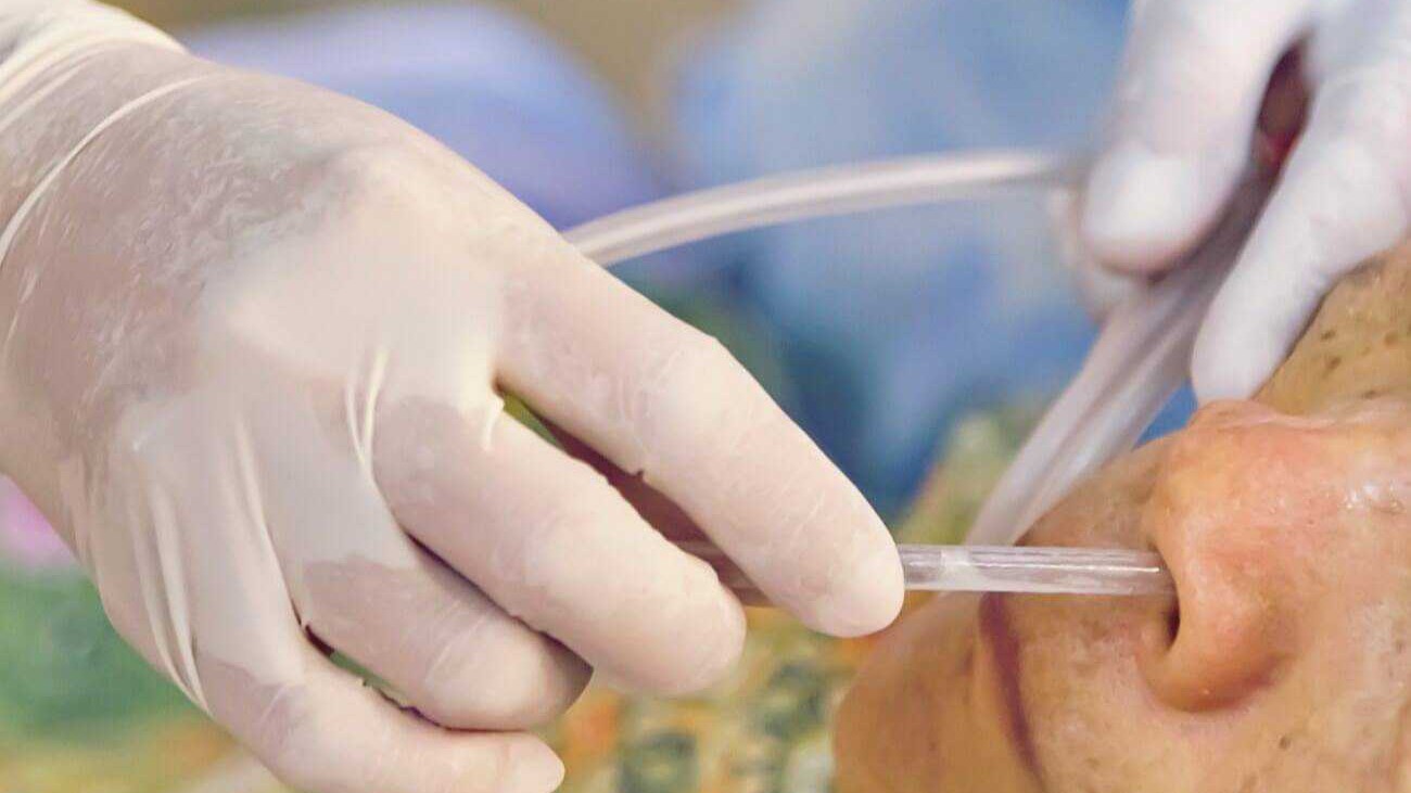 Ryles Tube Insertion